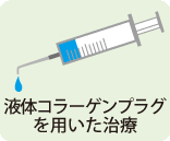 液体コラーゲンプラグを用いた治療