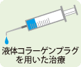 液体コラーゲンプラグを用いた治療